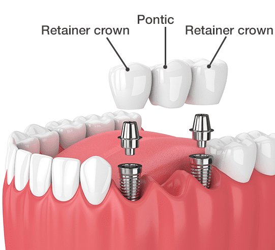 Dental Bridge Implants